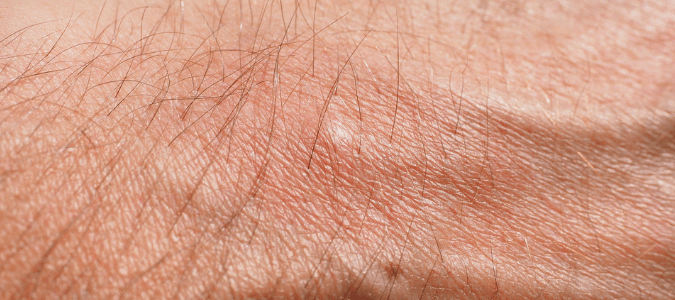 Difference between bed bug bites and mosquito bites