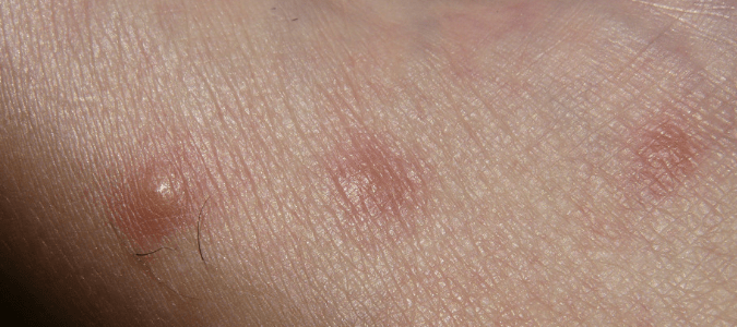 A row of bed bug bites