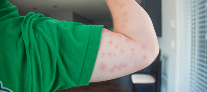 flea bites on a man's arm
