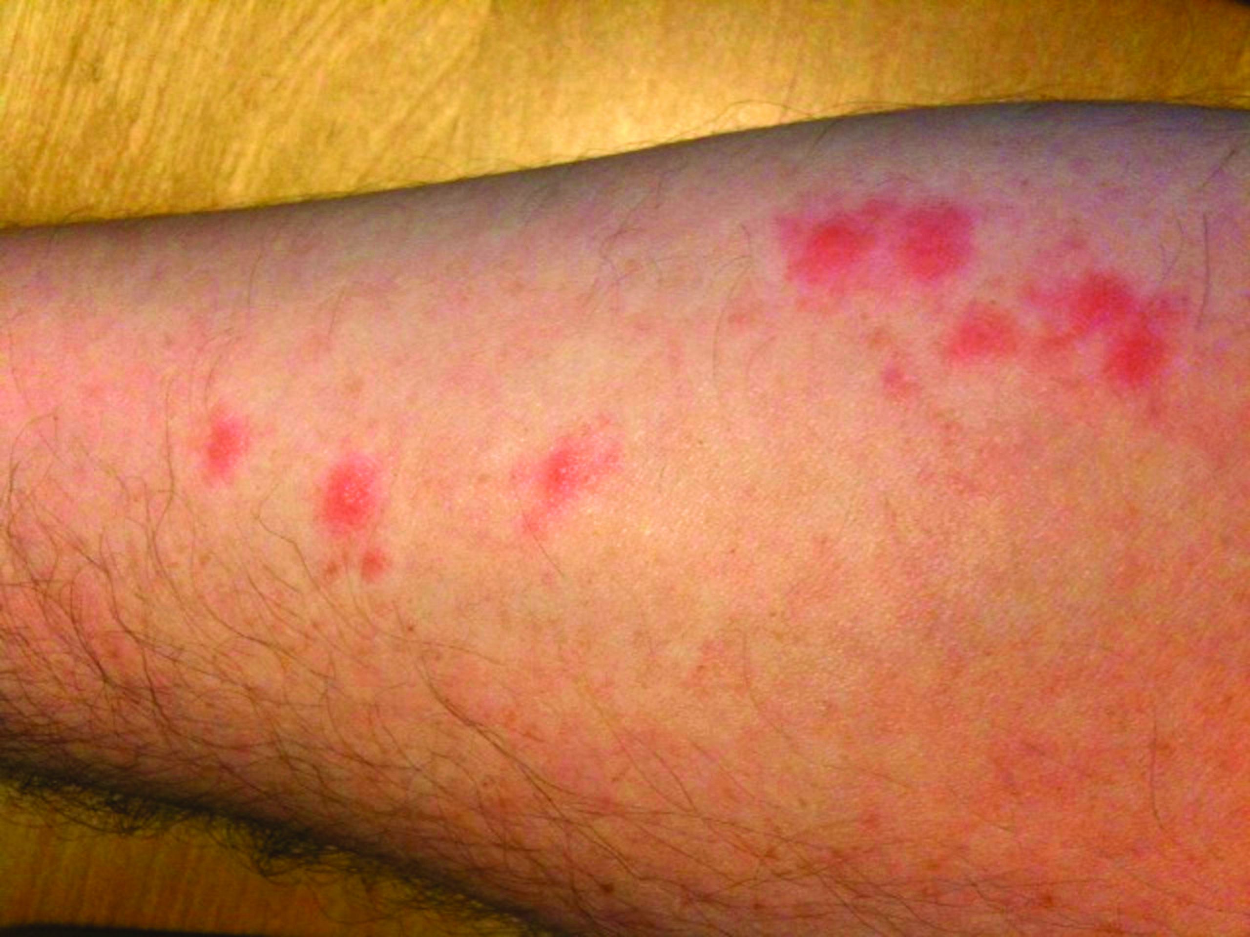 bed bug bites on a leg