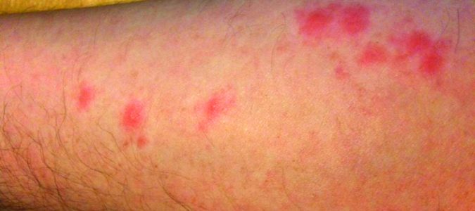 bed bug bites on an arm