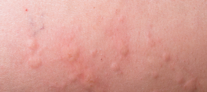 hives
