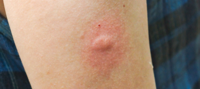 a mosquito bite
