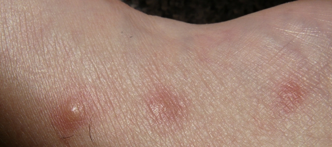 Termite bites on skin