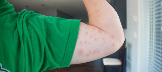 flea bites